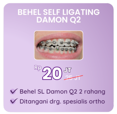 promo-behel-self-ligating-damon-q2-hai-gigi-premier