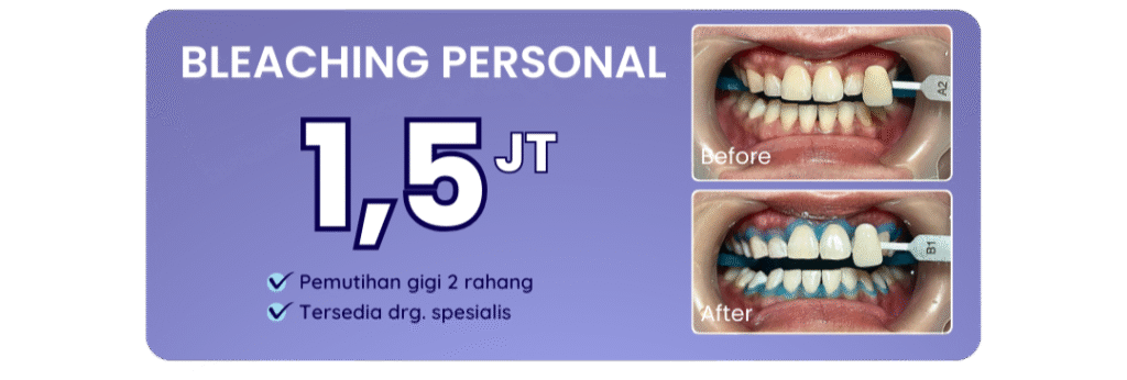 promo-bleaching-personal-hai-gigi-banyumanik