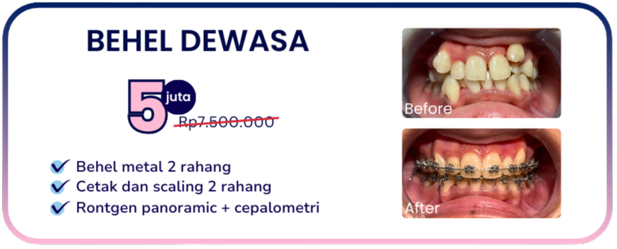 promo-hai-gigi-banyumanik-behel-dewasa