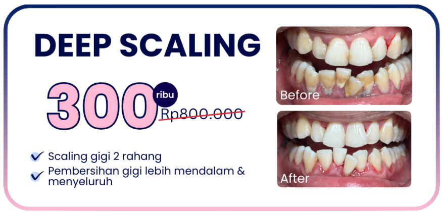 promo-hai-gigi-banyumanik-deep-scaling