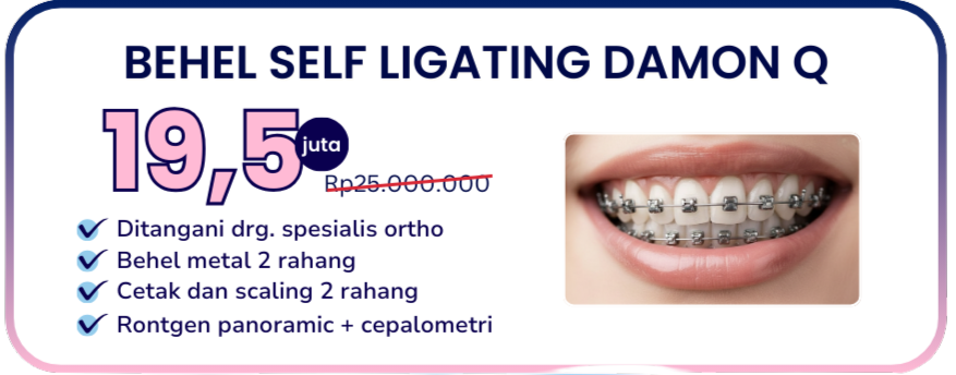 promo-hai-gigi-banyumanik-paket-behel-self-ligating-damon-q