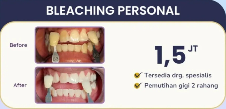 Bleaching Gigi promo-juni-hai-gigi-banyumanik