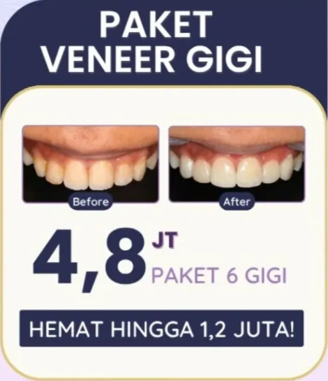 promo-juni-hai-gigi-banyumanik