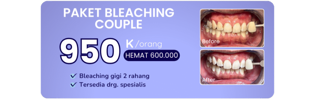 promo-paket-bleaching-couple-hai-gigi-banyumanik