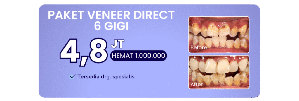 promo-paket-veneer-direct-hai-gigi-banyumanik