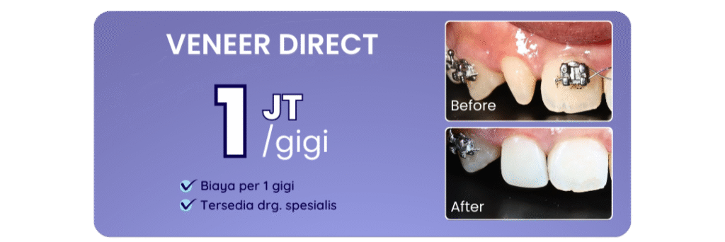 promo-veneer-direct-hai-gigi-banyumanik