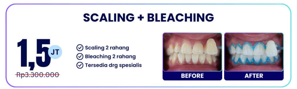 scaling-bleaching-hai-gigi-banyumanik