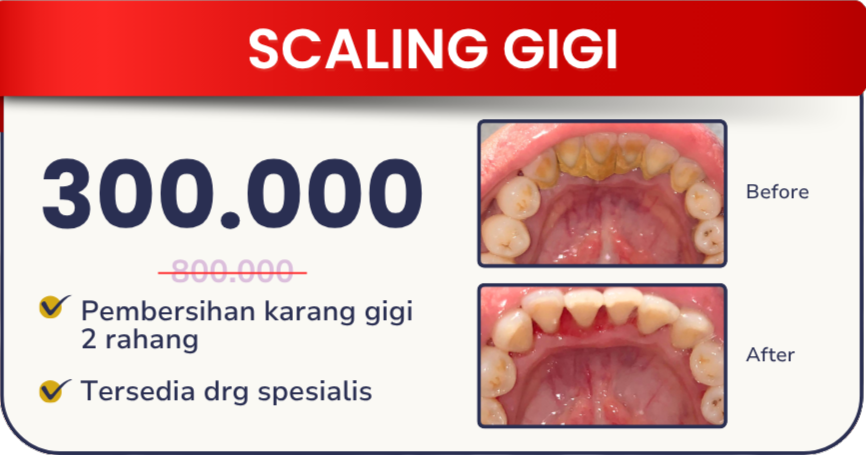 scaling-gigi-hai-gigi-banyumanik