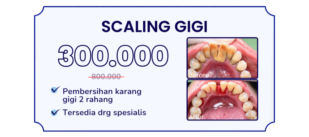 scaling-gigi-hai-gigi-banyumanik