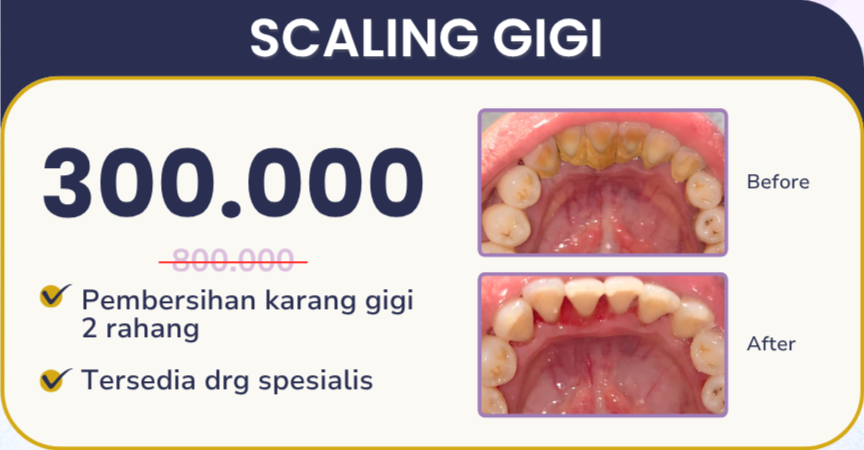 scaling gigi hai gigi banyumanik