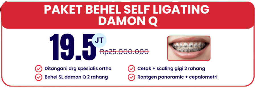 self-ligating-damon-q-hai-gigi-banyumanik