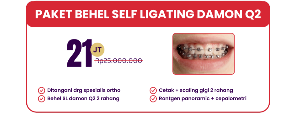 self-ligating-damon-q2-hai-gigi-premier