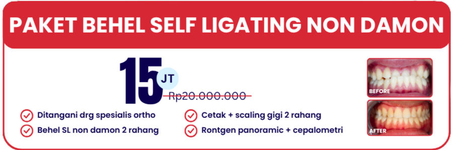 self-ligating-non-damon-hai-gigi-banyumanik