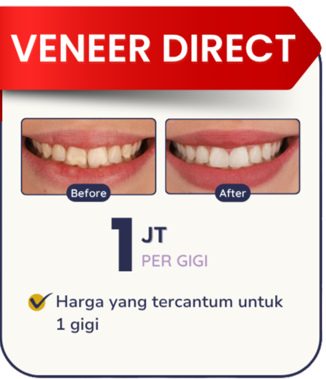 veneer-direct-hai-gigi-banyumanik