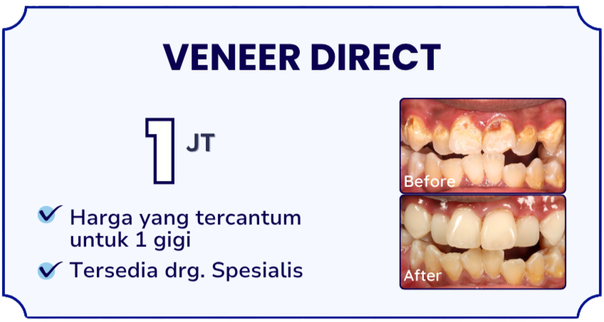 veneer-direct-hai-gigi-banyumanik