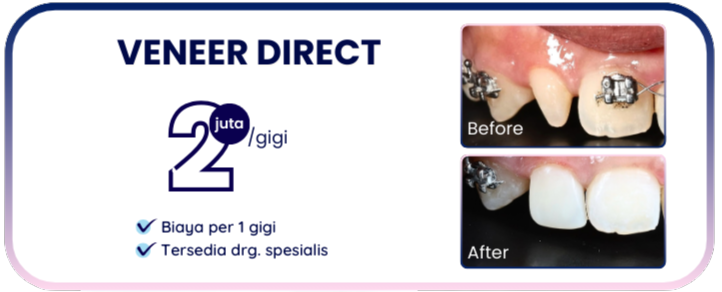 veneer-direct-hai-gigi-banyumanik
