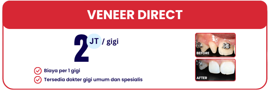 veneer-direct-hai-gigi-banyumanik