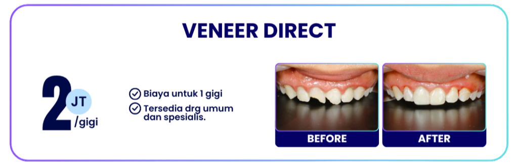 veneer-direct-hai-gigi-banyumanik