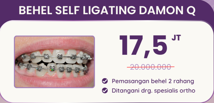 Promo behel self ligating damon Q hai gigi premier