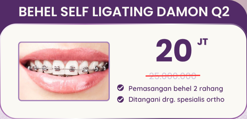 Promo behel self ligating damon Q2 hai gigi premier