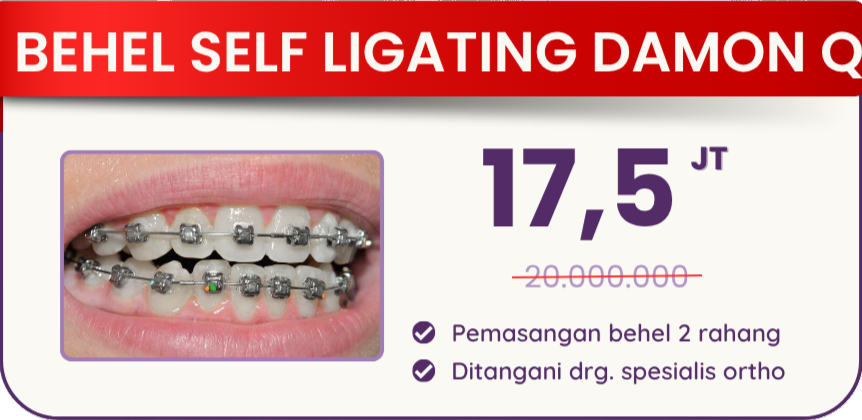 behel-self-ligating-damon-q-hai-gigi-premier