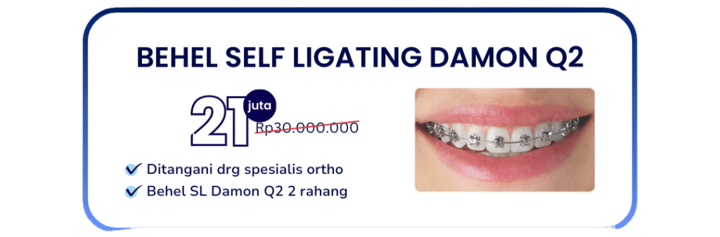 behel-self-ligating-damon-q2-hai-gigi-banyumanik