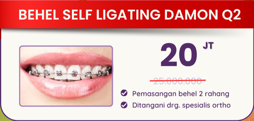 behel-self-ligating-damon-q2-hai-gigi-premier