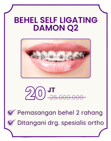 behel-self-ligating-damon-q2-hai-gigi-premier