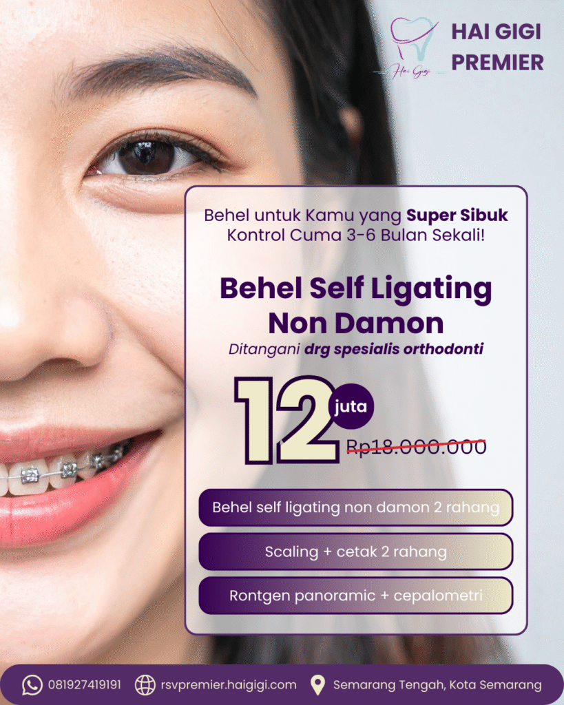 behel-self-ligating-hai-gigi-premier