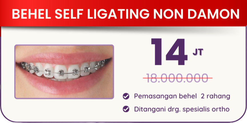 behel-self-ligating-non-damon-hai-gigi-premier