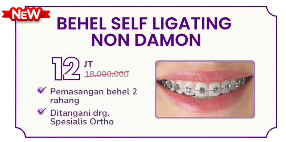 behel-self-ligating-non-damon-hai-gigi-premier