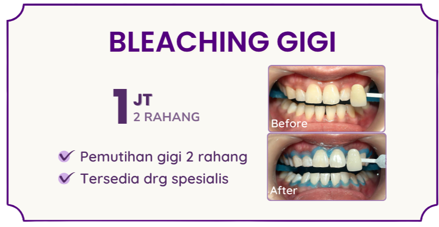 bleaching-gigi-hai-gigi-premier