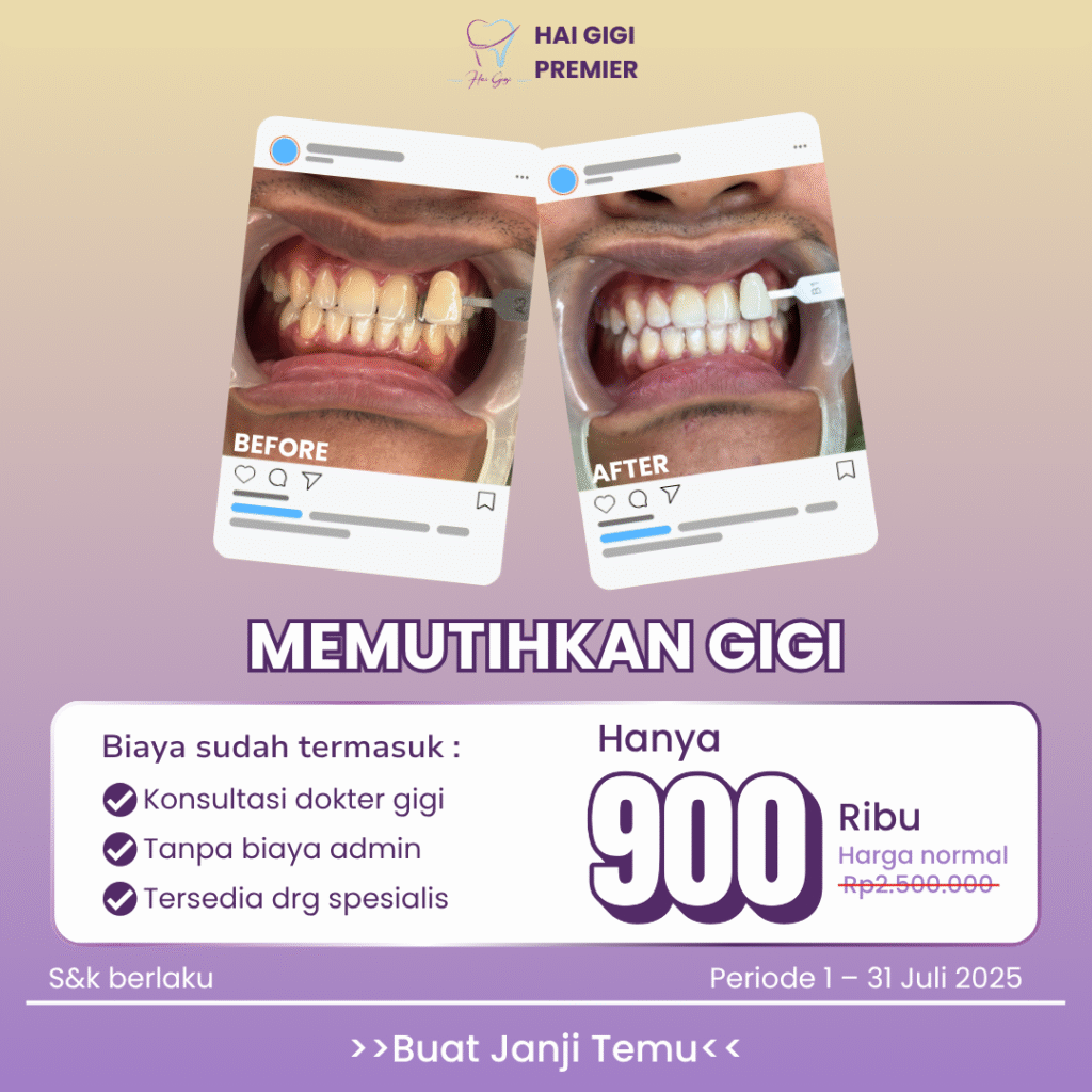 bleaching-pemutihan-gigi-hai-gigi-premier