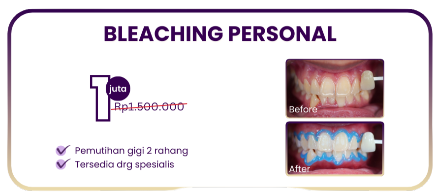 bleaching-personal-hai-gigi-premier