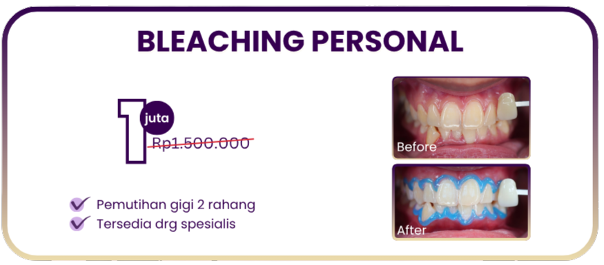 bleaching-personal-hai-gigi-premier