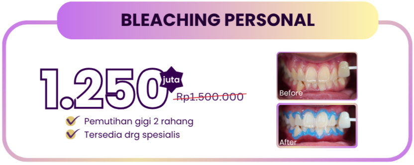 bleaching-personal-hai-gigi-premier