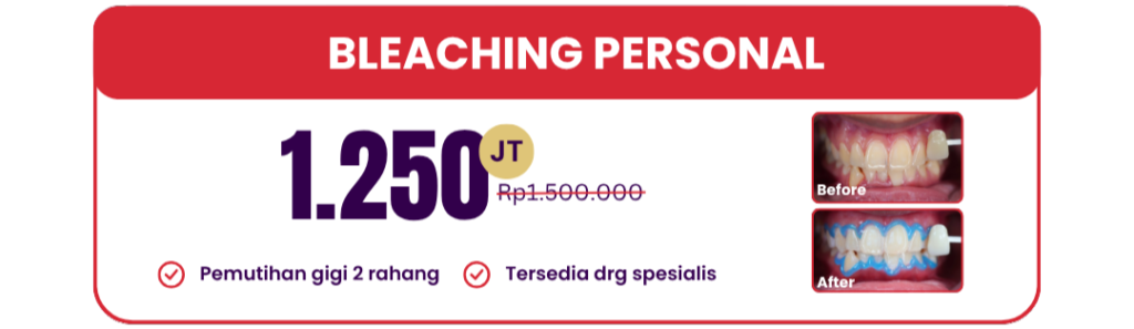 bleaching-personal-hai-gigi-premier