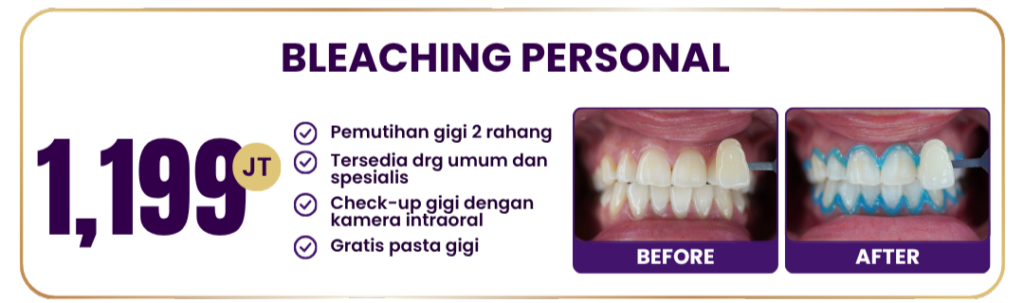 bleaching-personal-hai-gigi-premier