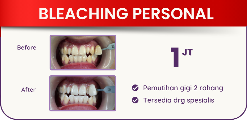 bleaching-personal-hai-gigi-premier