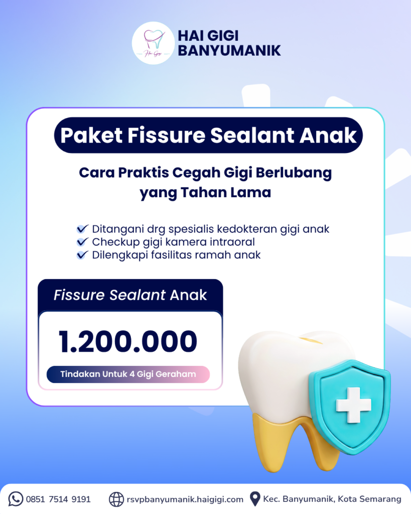 fissure-sealant-anak-hai-gigi-banyumanik