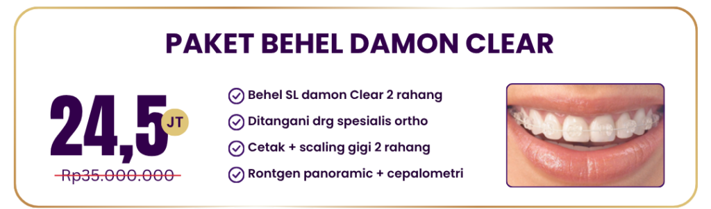 paket-behel-damon-clear-hai-gigi-premier