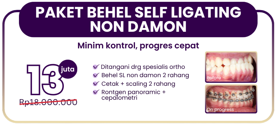 paket-behel-self-ligating-non-damon-hai-gigi-premier