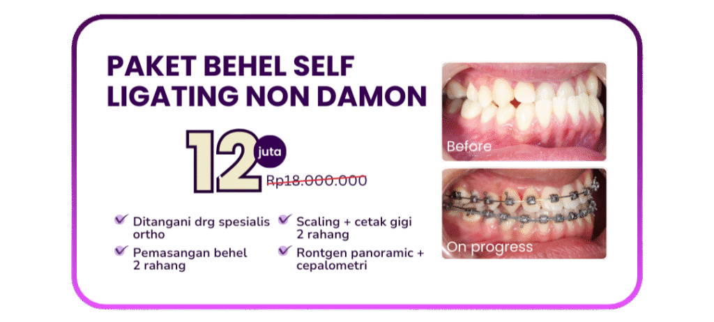 paket-behel-self-ligating-non-damon-hai-gigi-premier