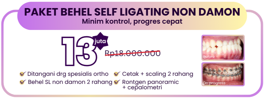 paket-behel-self-ligating-non-damon-hai-gigi-premier