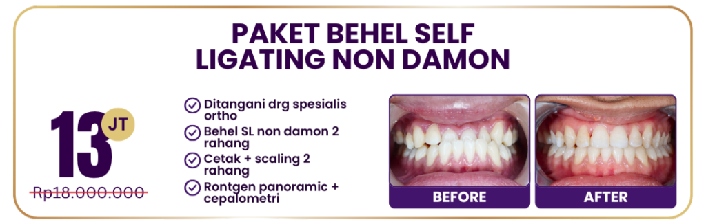 paket-behel-self-ligating-non-damon-hai-gigi-premier