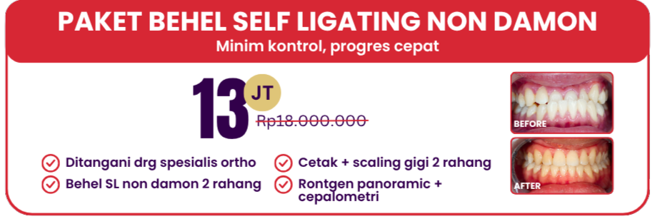paket-self-ligating-non-damon