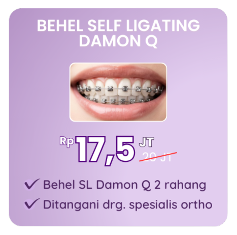 promo-behel-self-ligating-damon-q-hai-gigi-premier