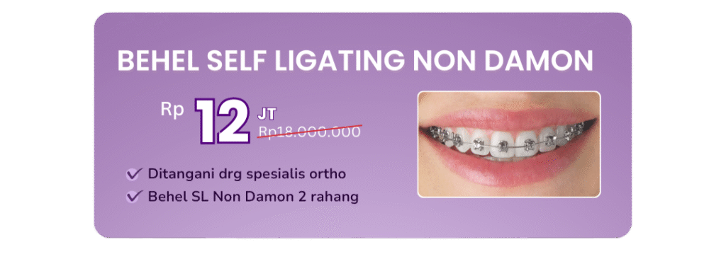 promo-behel-self-ligating-non-damon-hai-gigi-premier