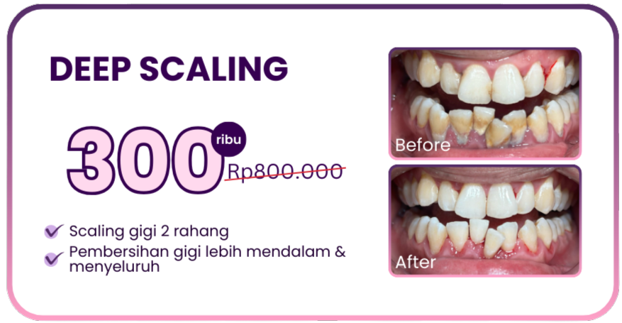 promo-hai-gigi-premier-deep-scaling