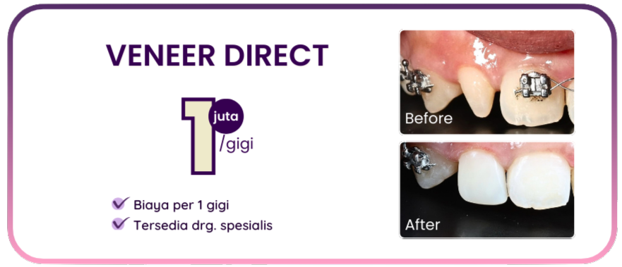 promo-hai-gigi-premier-veneer-direct